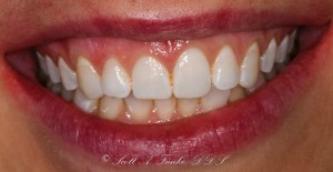 Before Conservative Composite Veneers