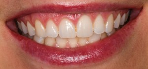 After Conservative Composite Veneers