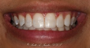 After Conservative Composite Veneers