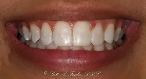 After Cosmetic Dental Treatment