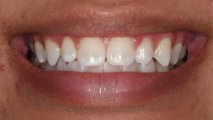 Before Conservative Composite Veneers