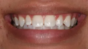 Before Cosmetic Dental Treatment