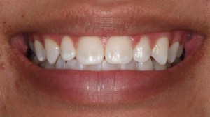 Before Conservative Composite Veneers