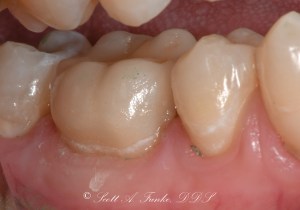 After CEREC Same Day Crowns Case #1