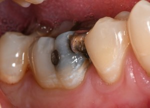 Before CEREC Same Day Crowns Case #1 