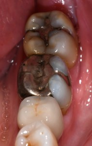 Before CEREC Same Day Crowns Case #5