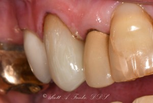 After CEREC Same Day Crowns Case #4