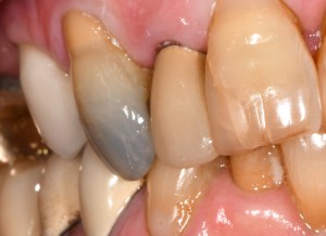 Before CEREC Same Day Crowns Case #3