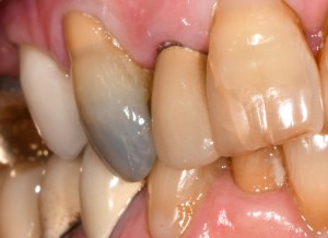 Before CEREC Same Day Crowns Case #3