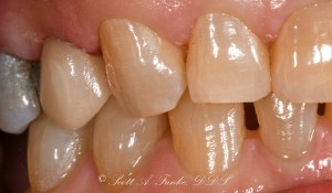 After CEREC Same Day Crowns Case #2