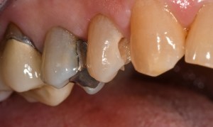 Before CEREC Same Day Crowns Case #2