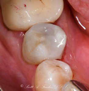 After Tooth Colored Filling Case #1