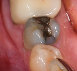 Before Tooth Colored Filling Case #1