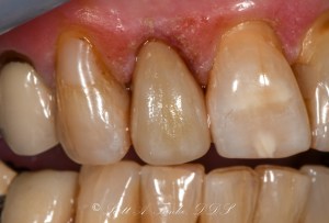 Before CEREC Same Day Crowns Case #6