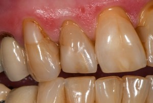 After CEREC Same Day Crowns Case #7