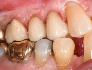 After CEREC Same Day Crowns Case #8
