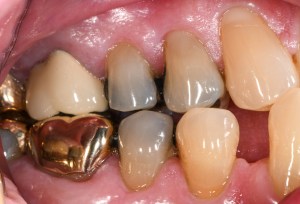 Before CEREC Same Day Crowns Case #7