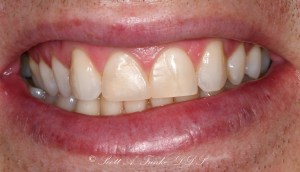 After Conservative Composite Veneers