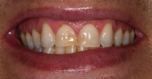 Before Conservative Composite Veneers