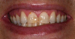 Before Conservative Composite Veneers