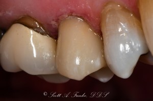 After CEREC Same Day Crowns Case #9