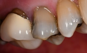 Before CEREC Same Day Crowns Case #8