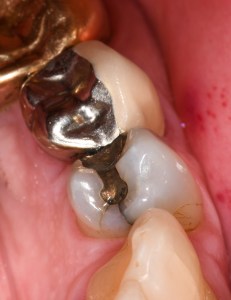 Before Tooth Colored Filling Case #4