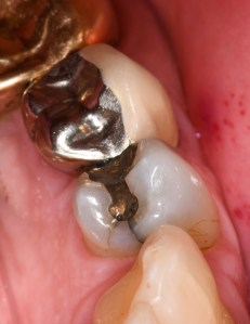 Before Tooth Colored Filling Case #4