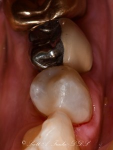 After Tooth Colored Filling Case #4