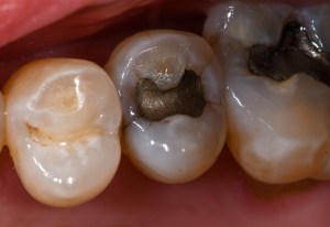 Before Tooth Colored Filling Case #3