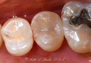 After Tooth Colored Filling Case #3