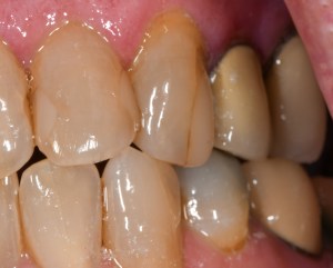 Before CEREC Same Day Crowns Case #10