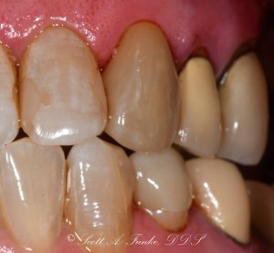 After CEREC Same Day Crowns Case #10