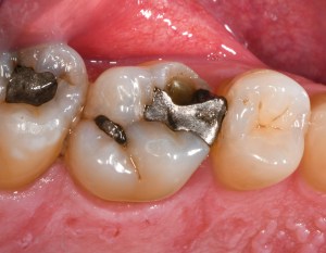 Before Tooth Colored Filling Case #2