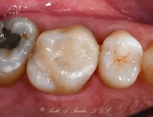 After Tooth Colored Filling Case #2