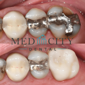Before & After Dental Crowns Case Case #2