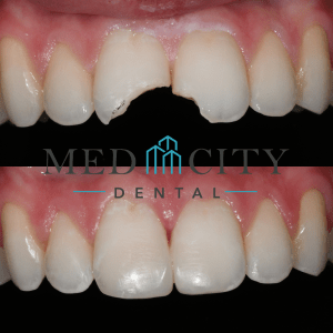 Before & After  Dental Bonding Case #1 - Smile Gallery