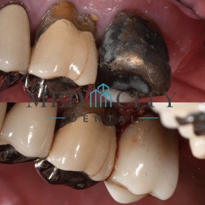CEREC Same Day Crowns Case #8 - Smile Gallery
