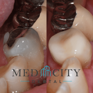 CEREC Same Day Crowns Case #5 - Smile Gallery