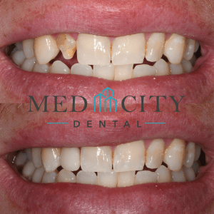 CEREC Same Day Crowns Case #7 - Smile Gallery