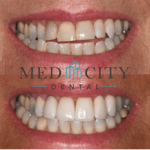 Before and After Dental Crowns Case #1