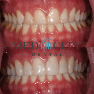 Before & After Dental Bonding Case #4
