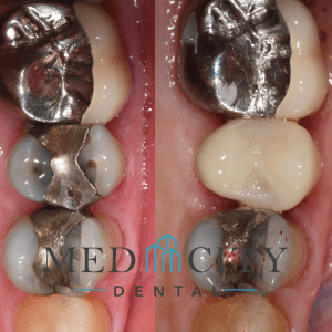 CEREC Same Day Crowns Case #6 - Smile Gallery
