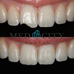 Before & After Dental Bonding Case #1