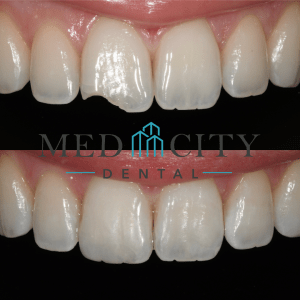 Before & After Dental Bonding Case #3