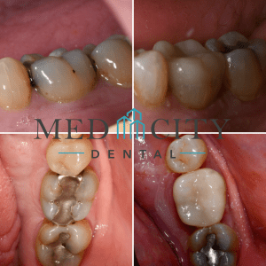 CEREC Same Day Crowns Case #1 - Smile Gallery