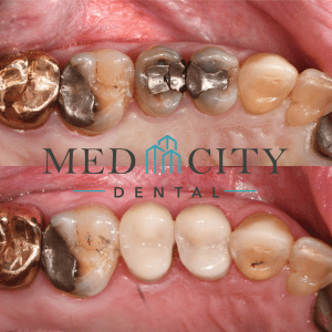 CEREC Same Day Crowns Case #3 - Smile Gallery
