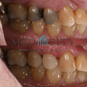 CEREC Same Day Crowns Case #4 - Smile Gallery