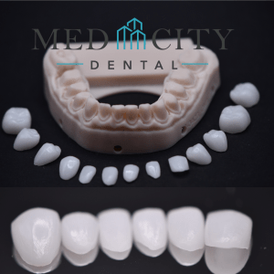 Full Mouth Restoration - Lower teeth Design