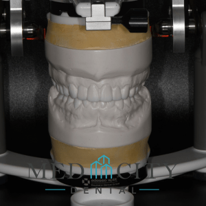 Full Mouth Restoration design